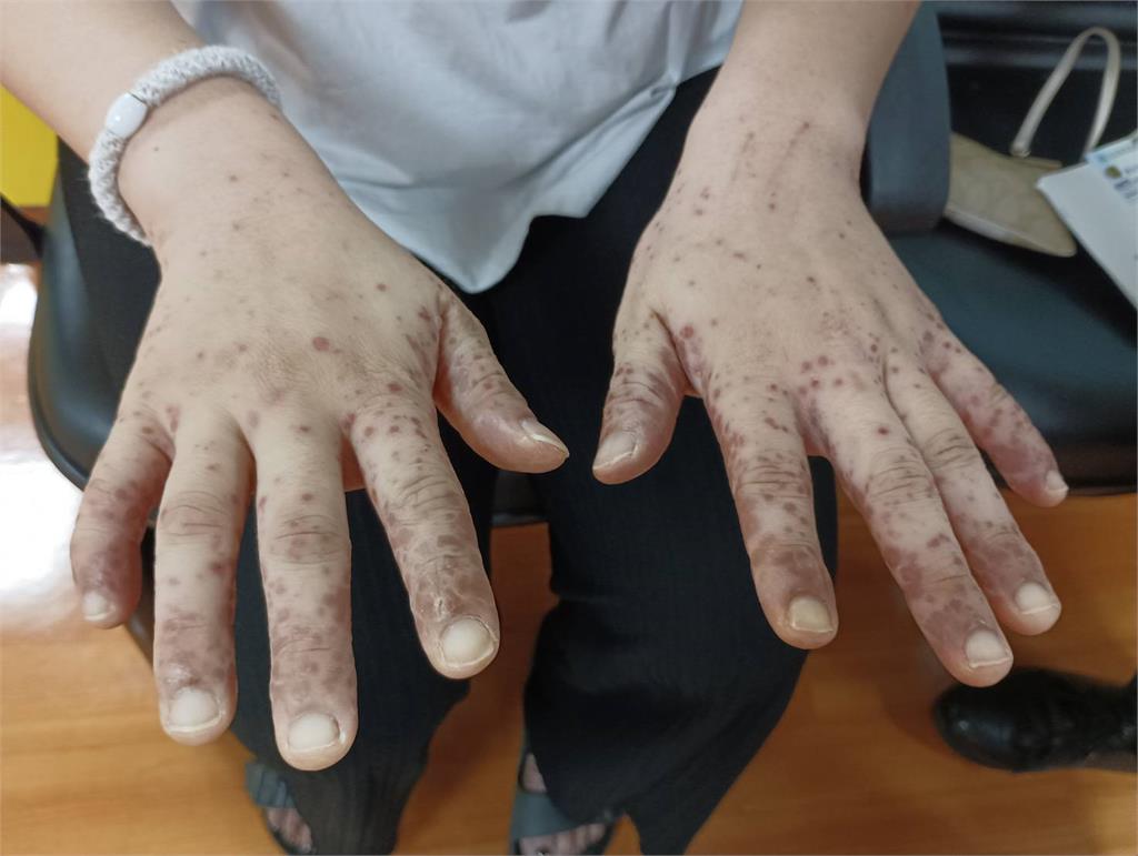 「這疾病」作祟！　雙寶媽手腳驚見密密麻麻紅疹染腸病毒