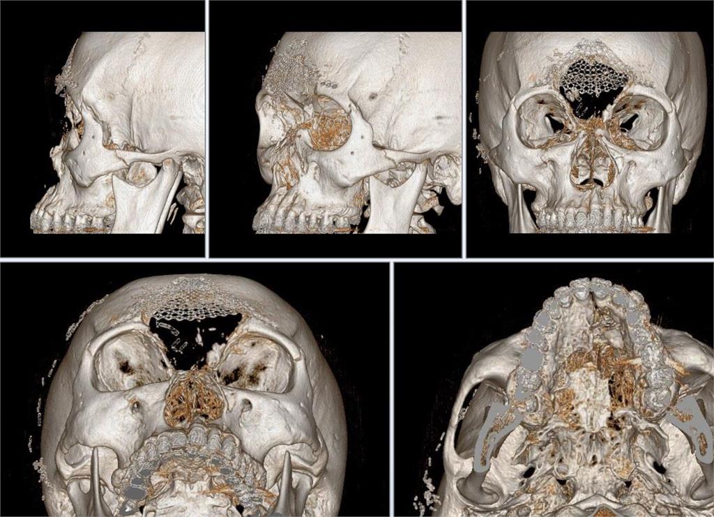 男遭T91步槍傷臉骨粉碎！   三總醫巧手+3D列印「拚回整張臉」