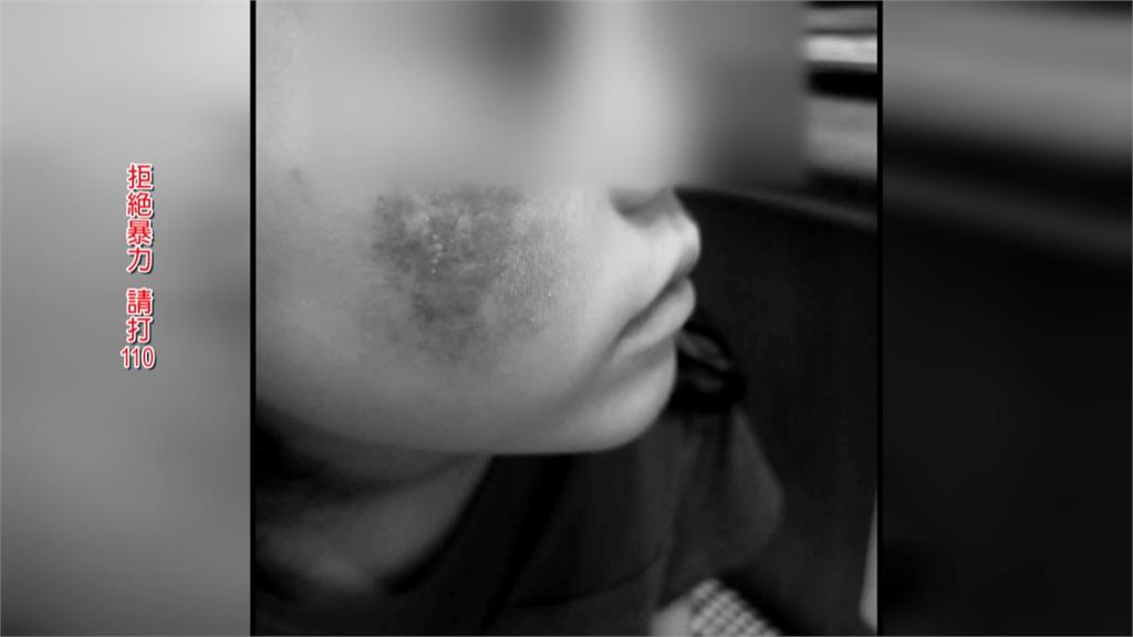 6歲童臉被老師用海綿刷到潰爛！媽媽反收幼兒園存證信函