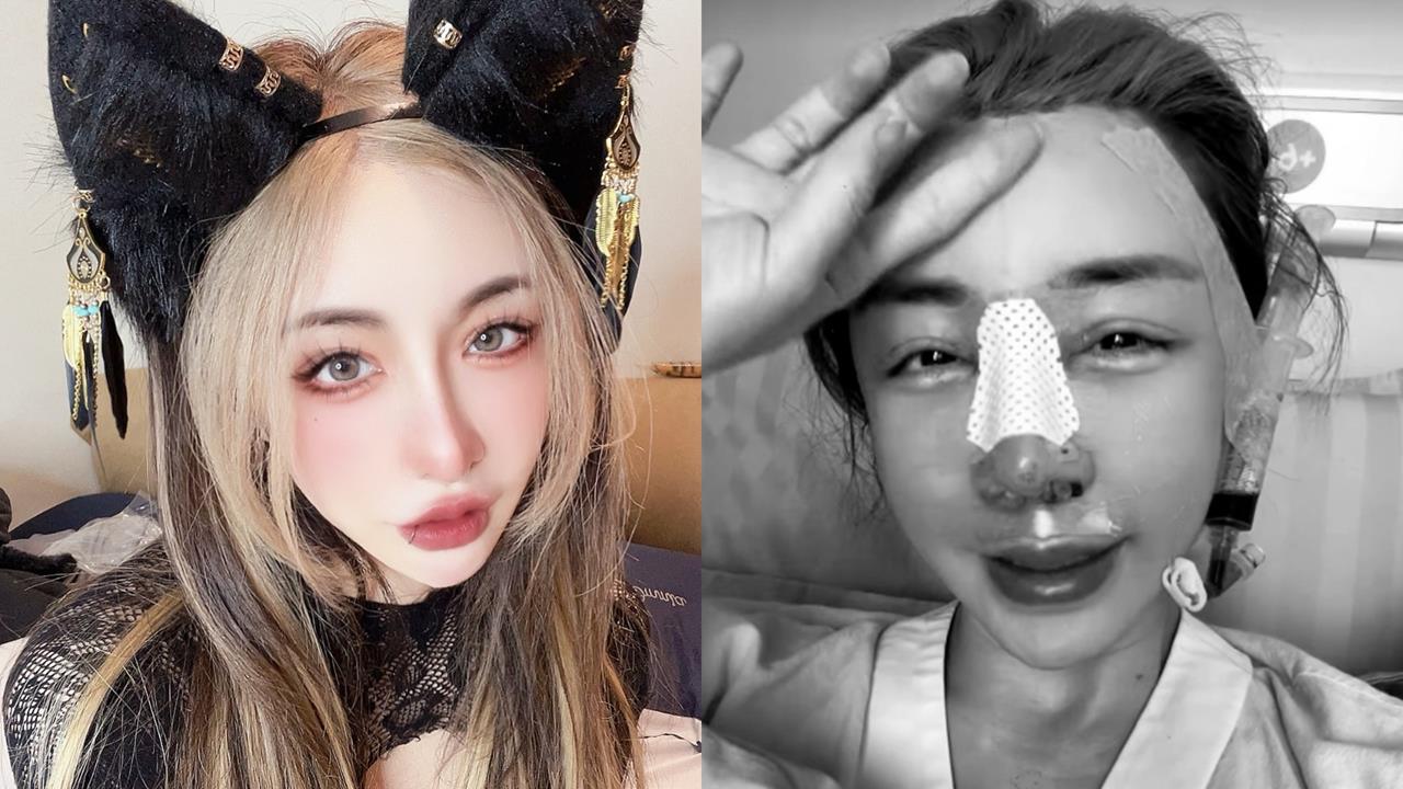 雪碧「12年假鼻」不要了！才爆「整形失敗」飛上海求醫⋯虛弱插管照流出