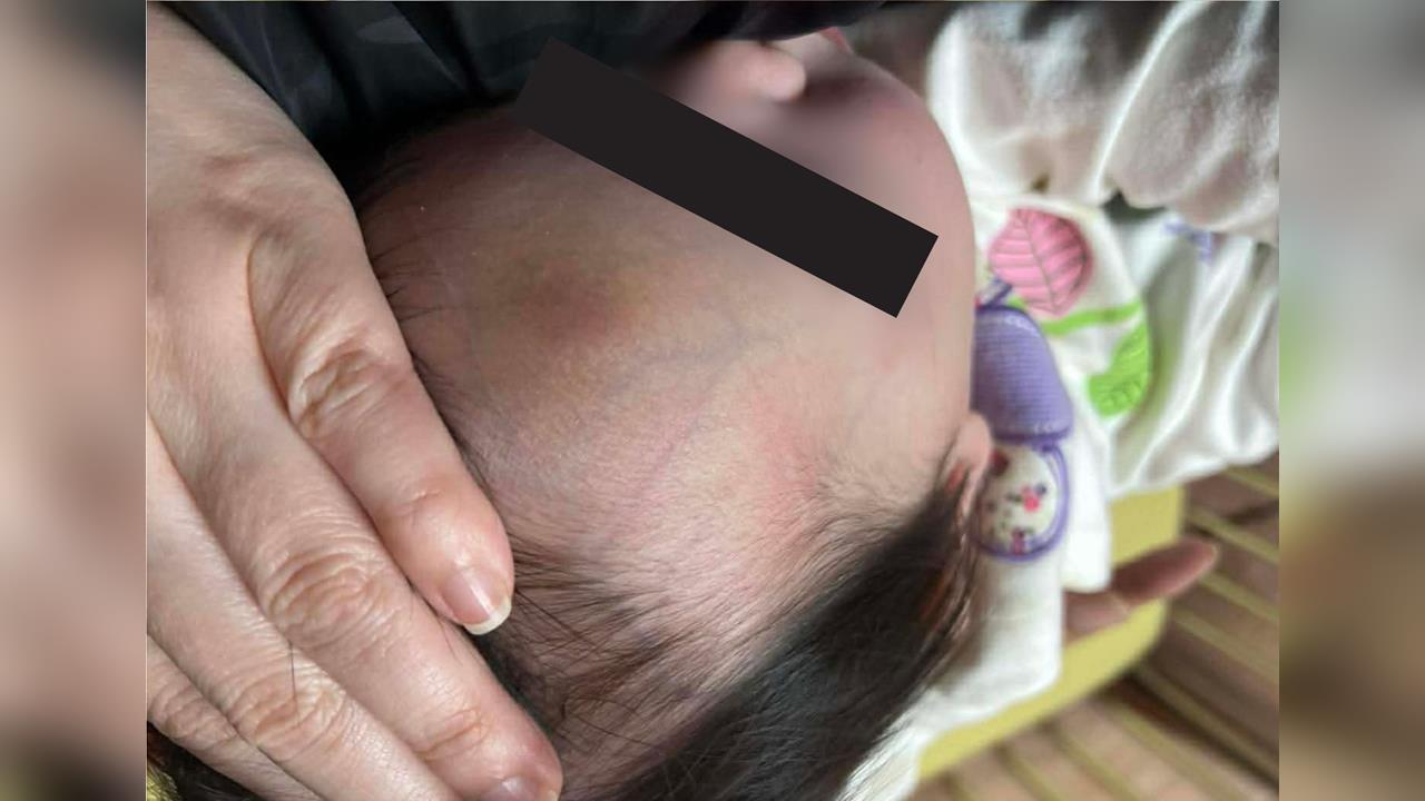 快新聞／剴剴案翻版？1歲童送安置機構疑遭施暴　頭部等處瘀青畫面曝光