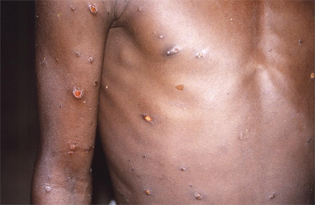 新加坡猴痘病例＋1　28歲台男肌肉疼痛冒皮疹、有加拿大旅遊史