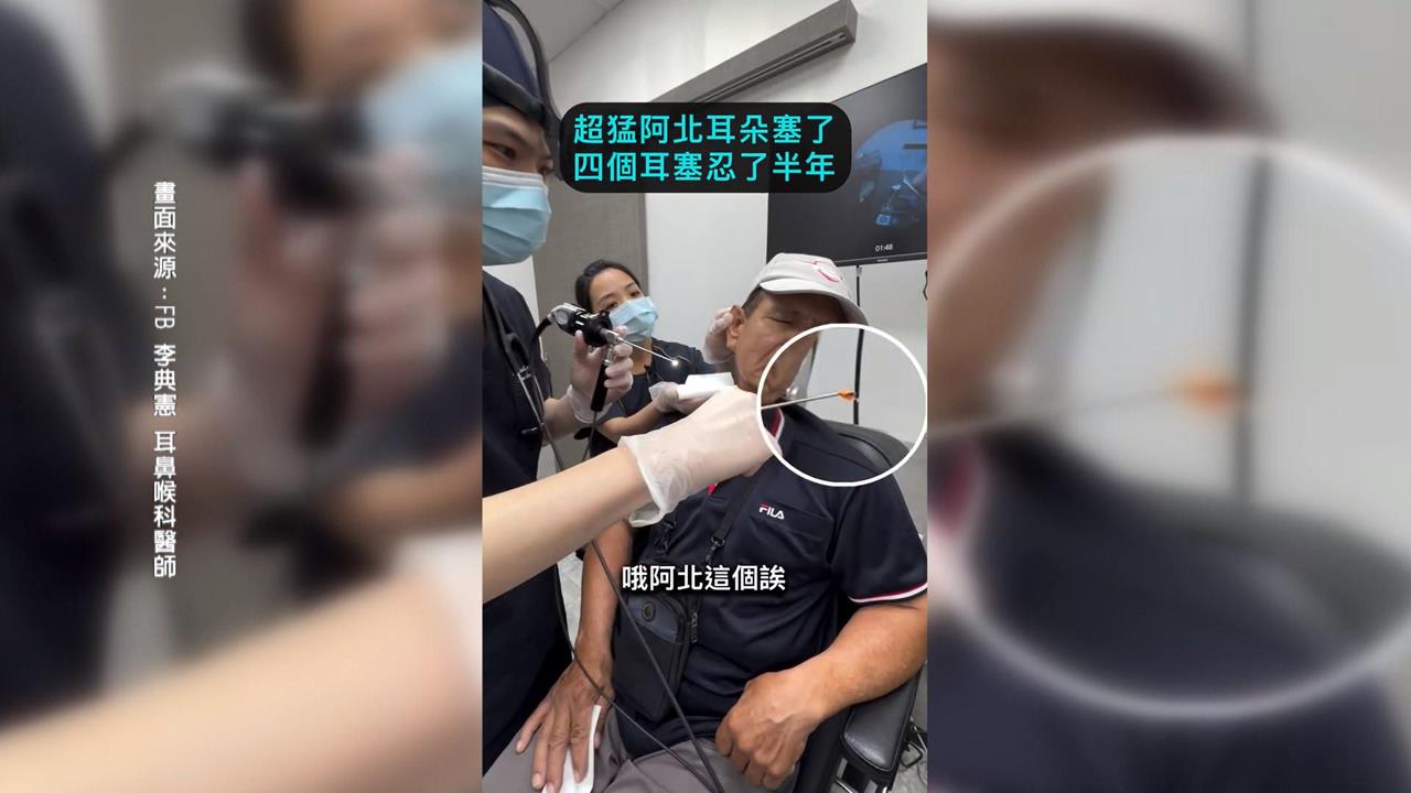 驚！雙耳卡4個耳塞殘骸　全部取出後60歲翁喊「都聽到了」