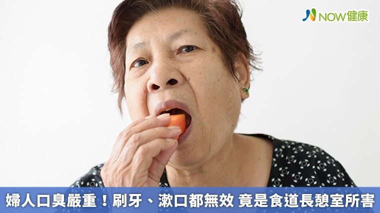 婦人口臭嚴重！刷牙、漱口都無效　竟是食道長憩室所害