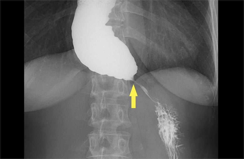 她一吃東西就胸悶竟是罕病！   「鳥嘴狀食道」卡住食物