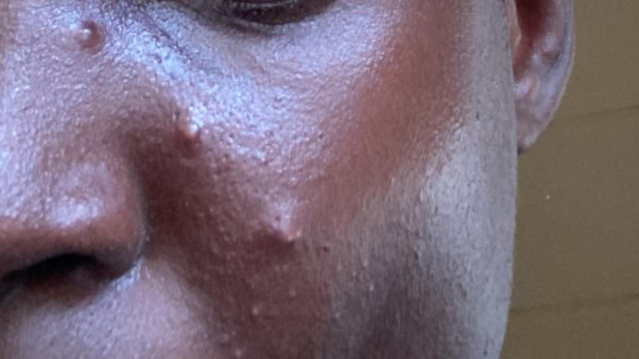 臉上痘痘別亂擠！醫示警「危險三角區」千萬別碰：一不小心就喪命