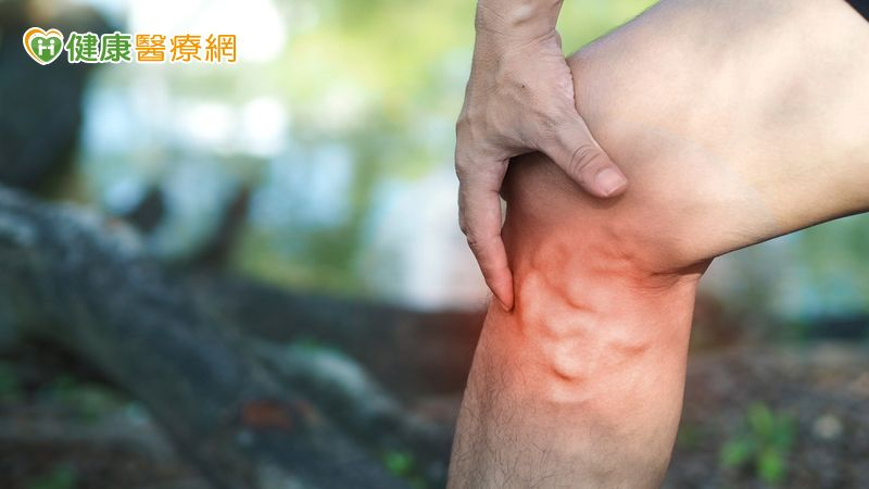 靜脈曲張治療怎麼選?醫解析「最新微創技術」 高齡族群也適合