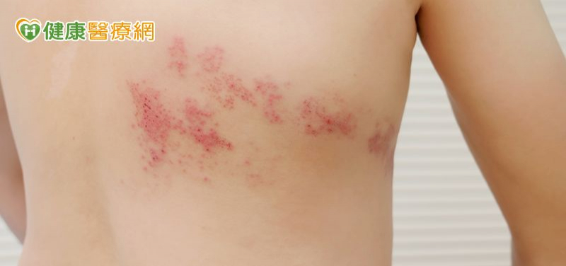 背痛到像被火燒竟是帶狀皰疹！醫：「這樣做」可大幅降低復發與後遺症