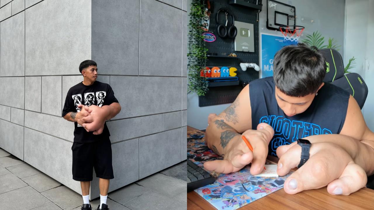 雙手比常人大10倍！菲男罹罕病　手錶成戒指、牙刷水杯成迷你玩具