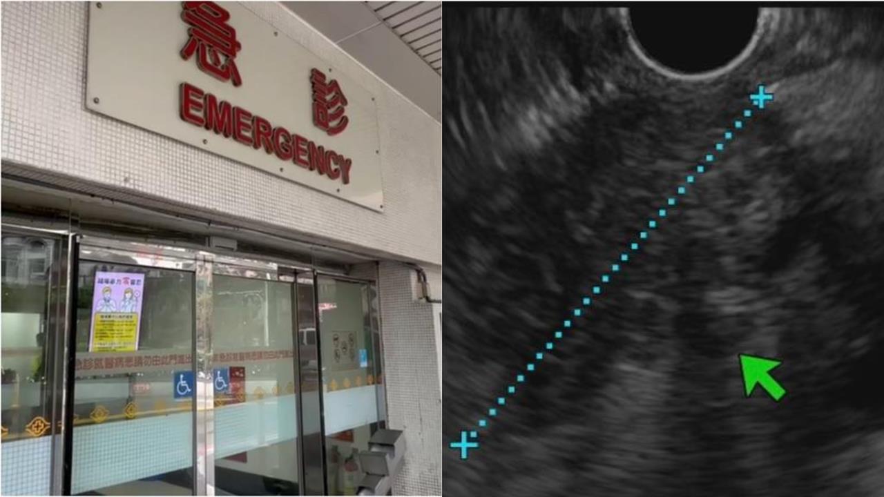 半年瘦10公斤「女腹痛就醫」胃沒問題!醫見2症狀「一照胰臟」已是三期癌