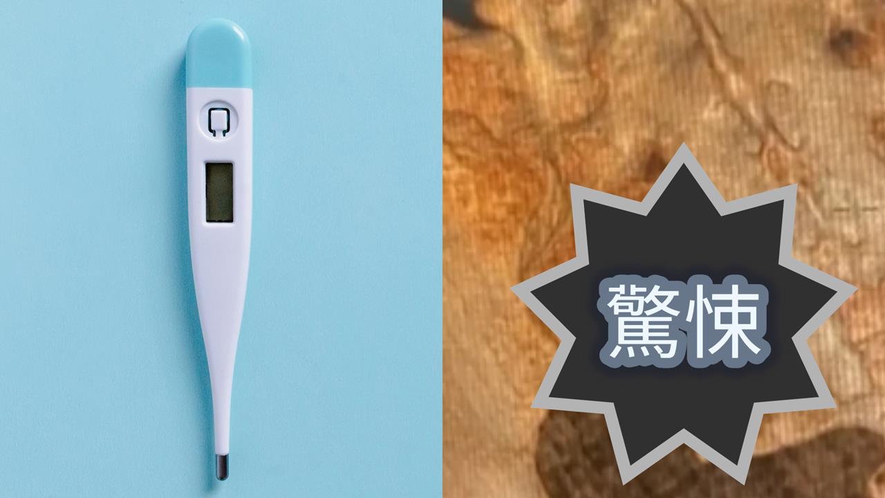 女子屁股驚見「2cm體溫計殘片」！深藏「22年不知情」醫師見1幕嚇壞