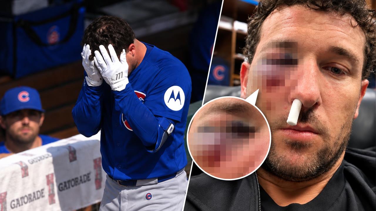 MLB(影)／恐怖界外球直擊臉部！布萊格曼左眼腫到睜不開　自拍喊「我會回來」