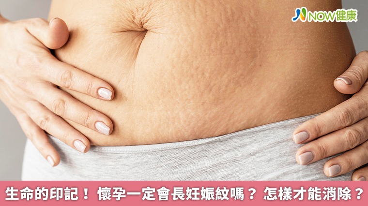 生命的印記！懷孕一定會長妊娠紋嗎？怎樣才能消除？