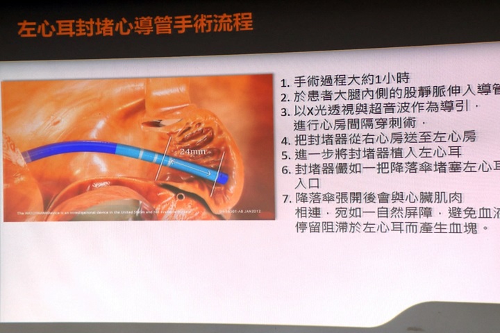 「心房顫動」增加中風危機  台大研發新技術預防