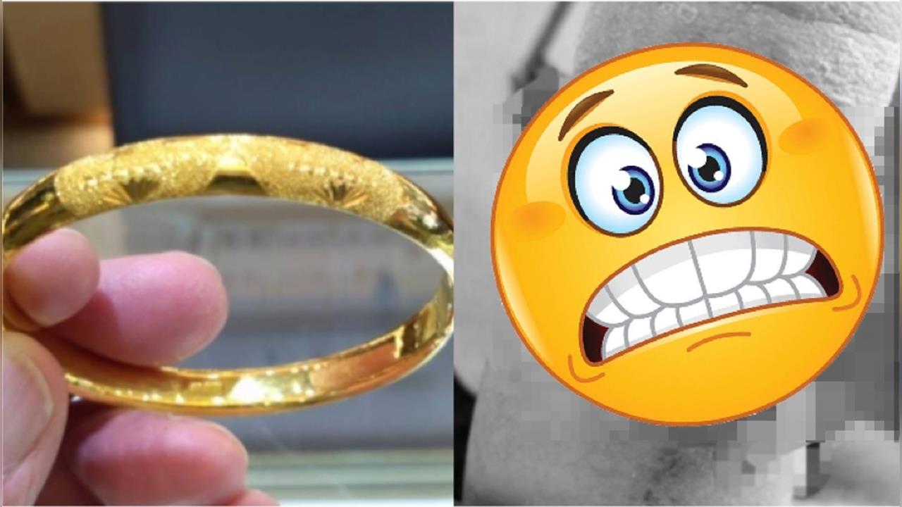 33歲女「手鐲戴10年」沒脫！因體型改變「嵌進肉裡」手腕潰爛畫面曝光