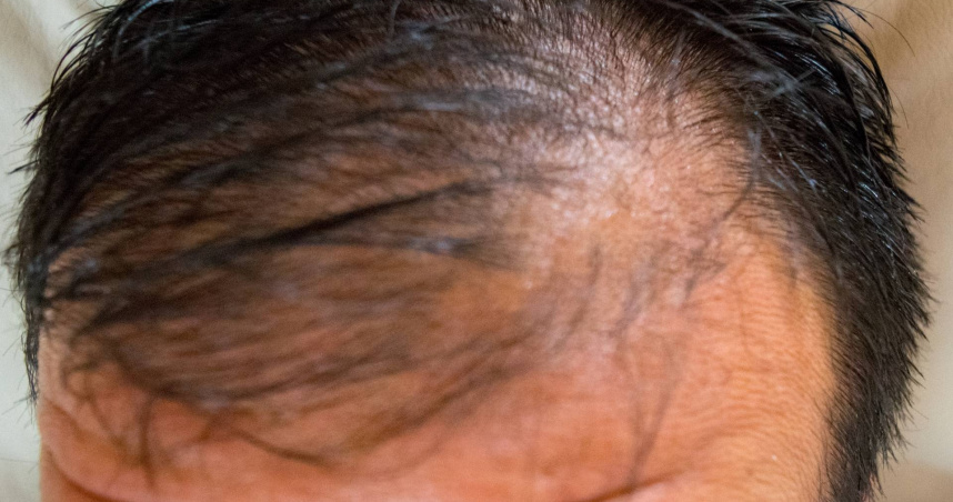 狂吃蛋能生髮？男每天吞3顆生蛋救髮際線　醫示警：結果恐更慘