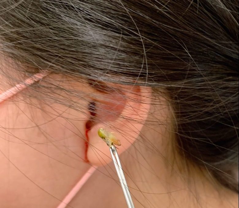 女童喊左耳疼痛 聯新國際醫檢查竟是蟋蟀卡耳道