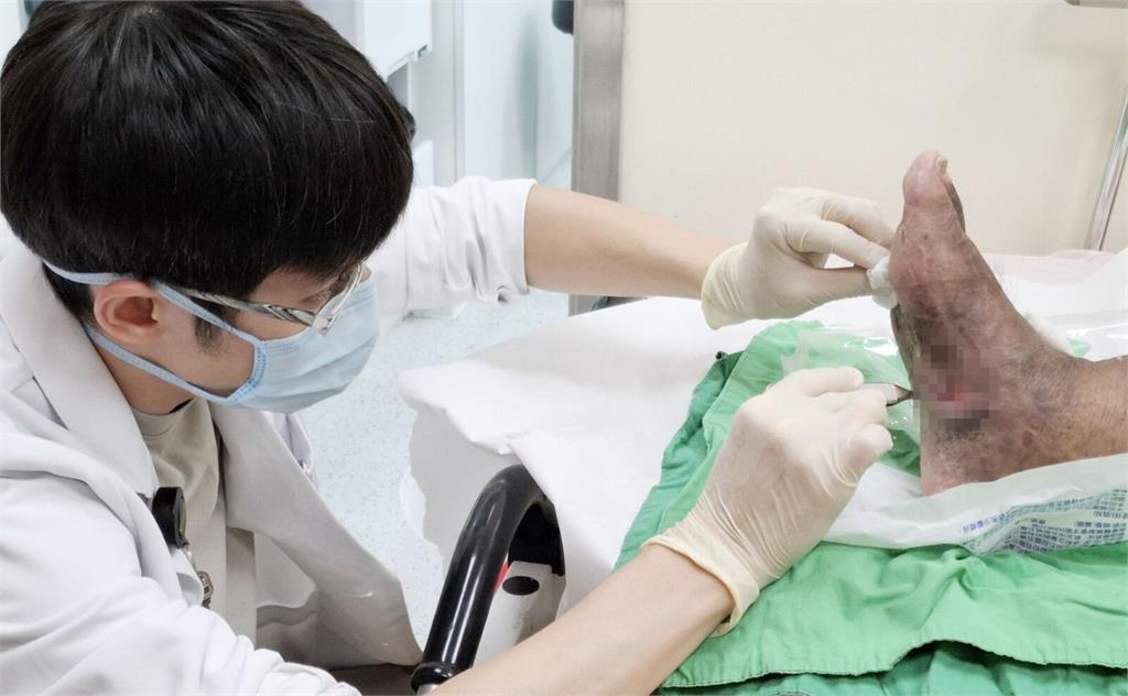 糖尿病男踩尖物「腳底破了一點皮」   再看已紅腫化膿、壞死險截肢！