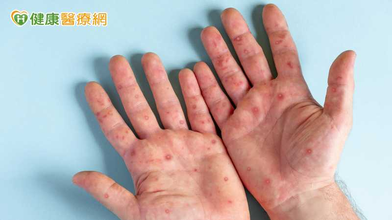 開學腸病毒緩升!未滿5歲男童染D68型重症 全身無力、嗜睡送加護