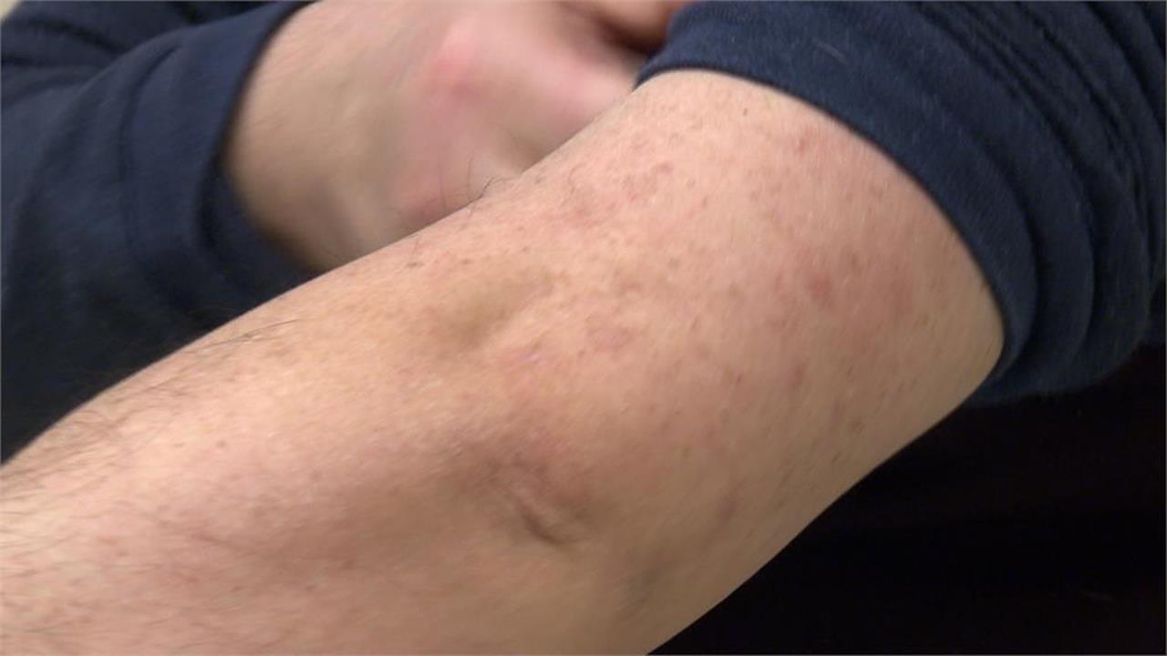 香港腳灰指甲老是好不了？專家提這3核心概念　曝：這類族群最危險！