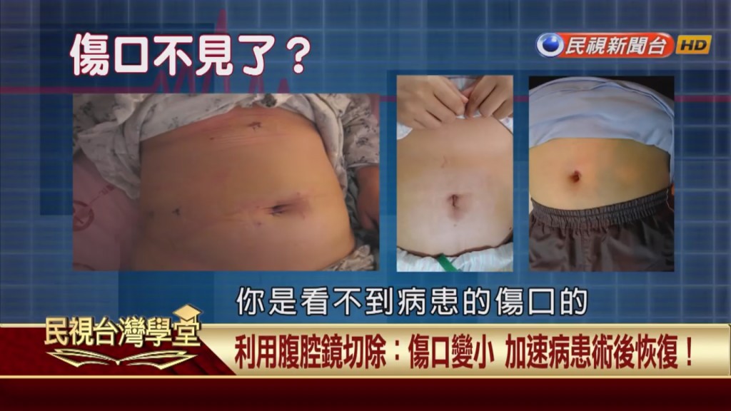 闌尾手術傷口小到看不見?不只美觀甚至還沒疼痛感?