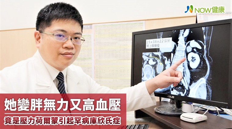 她變胖無力又高血壓 竟是壓力荷爾蒙引起罕病庫欣氏症