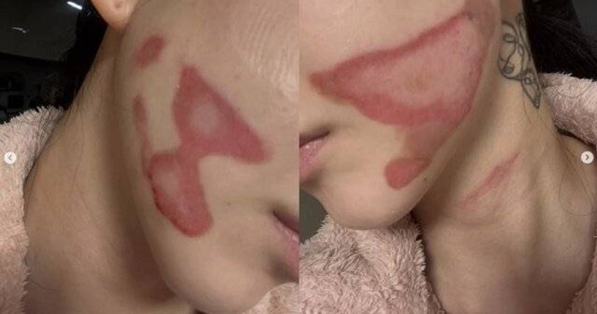 AOA前成員元旦輕生未遂！突自爆遇醫美事故「臉部毀容」　驚悚傷勢曝光