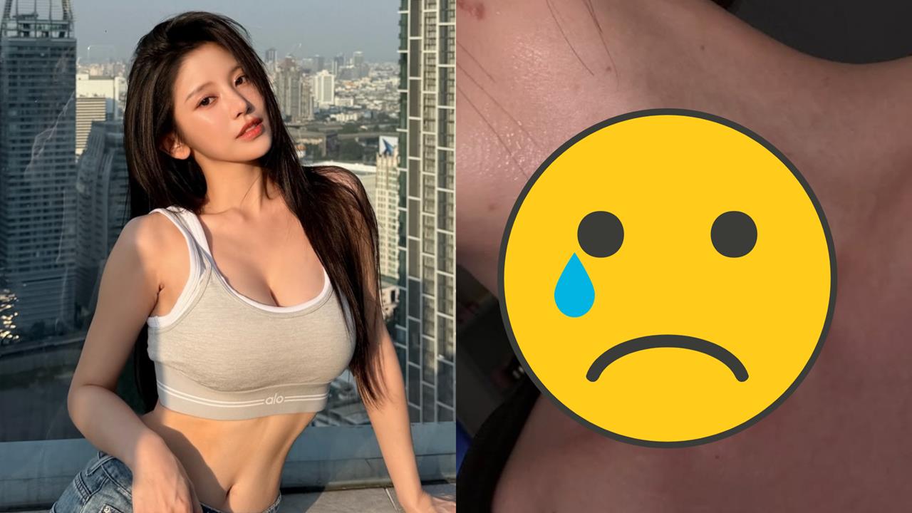 蔡瑞雪健康亮紅燈!突PO脖子「紅腫化膿照」 認1病纏身:正在治療中