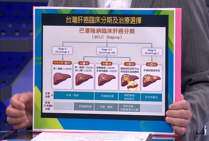 名醫妙方/肝腫瘤消融、肝動脈栓塞、放射手術 組合醫療治肝癌!