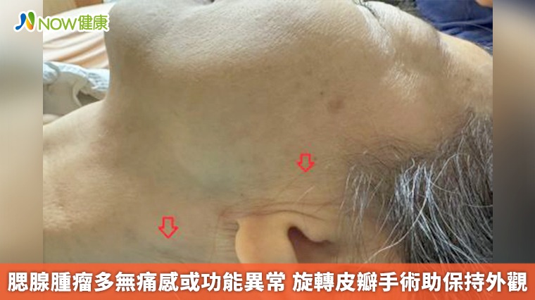 腮腺腫瘤多無痛感或功能異常 旋轉皮瓣手術助保持外觀
