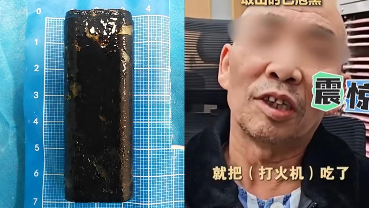 67歲老翁胃裡藏「30年前打火機」肚子爆痛！醫靠「1害羞小物」取出竟還能點火