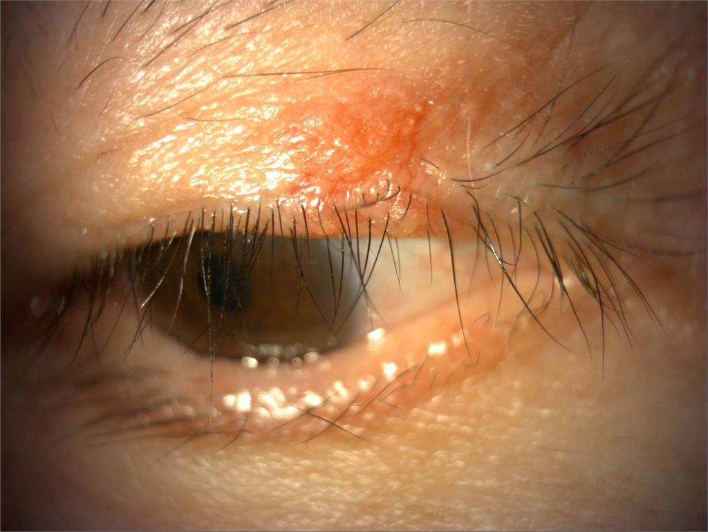 眼瞼紅腫痛求診!竟是蠕形蟎蟲寄生作怪