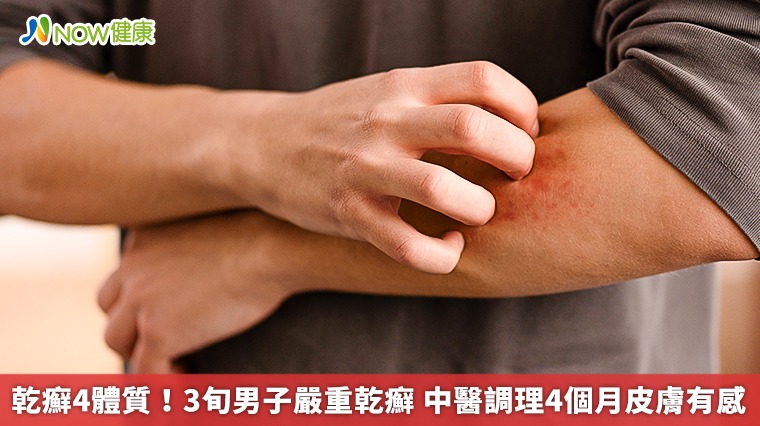 乾癬4體質！3旬男子嚴重乾癬　中醫調理4個月皮膚有感