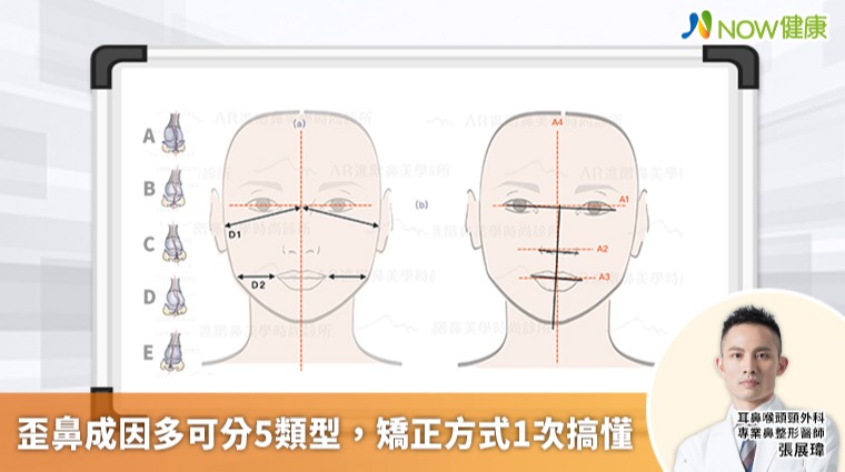 小金城武被翻出歪鼻舊照 歪鼻成因多矯正方式1次搞懂