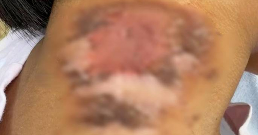 「行走的硫酸」大爆發！4歲妹沾到毒液脖子潰爛　20多天好不了