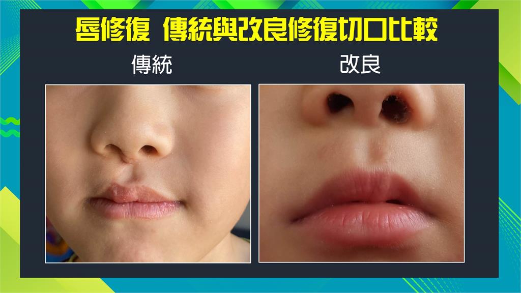 名醫妙方／負情緒OUT　唇修復技術提升再造唇顎裂美麗人生！　