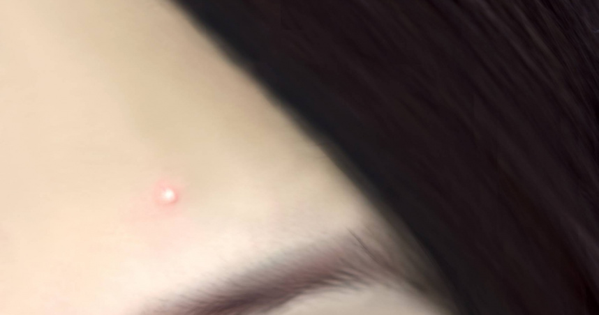 痘痘貼用錯更慘！　醫列「3種痘痘」不適合貼：恐讓發炎升級