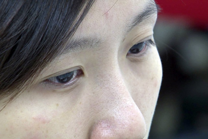 乾癬病人眼睛易得葡萄膜炎！嚴重恐致白內障