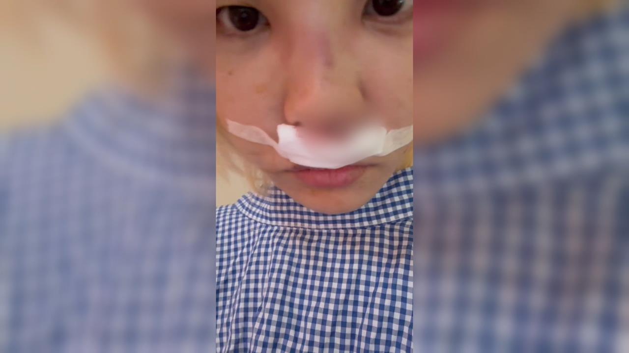 網紅苡琍控鼻雕埋線用「非法線材」險失明　吳紹琥：不實指控