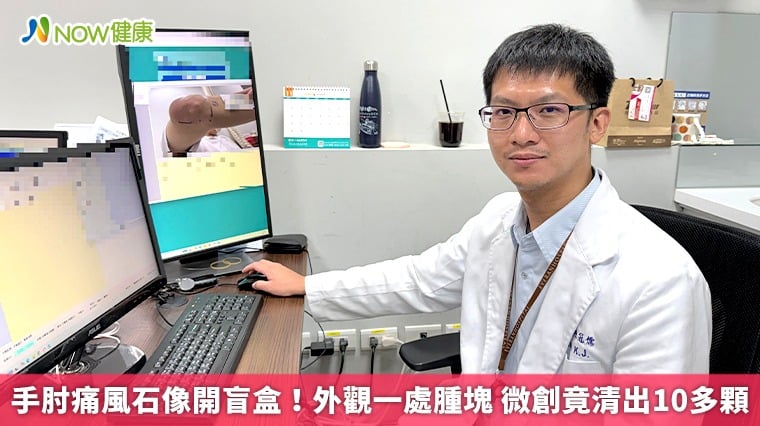 手肘痛風石像開盲盒!外觀一處腫塊 微創竟清出10多顆