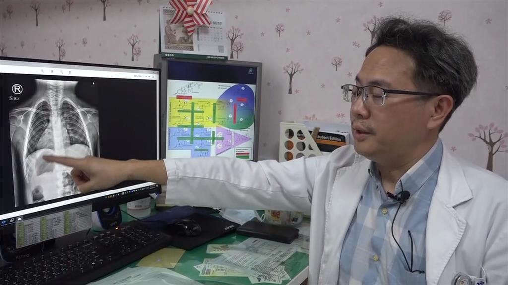 不到萬分之1機率「鏡面人」彰化3歲女童內臟左右相反
