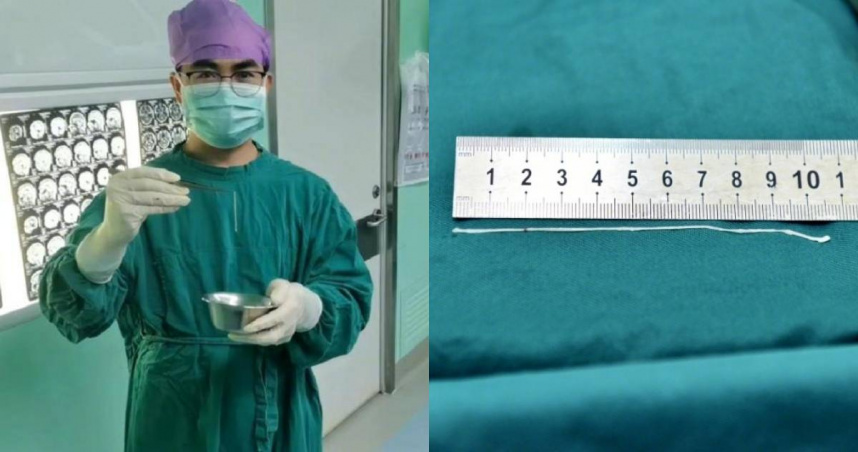 兒時曾喝生水、用井水刷牙！37歲男突失聲、腦袋抽搐　竟發現10公分寄生蟲入侵大腦