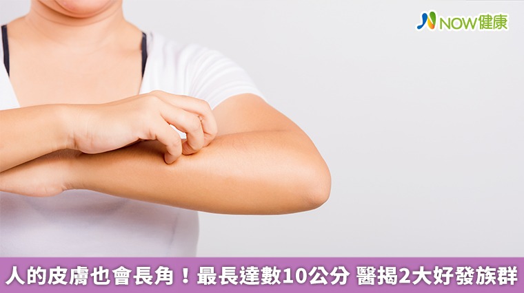 人的皮膚也會長角！最長達數10公分　醫揭2大好發族群