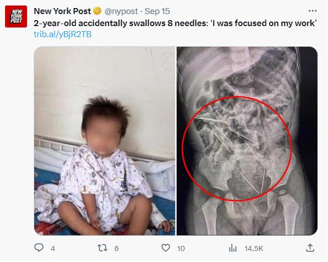 快新聞／嚇瘋！　秘魯2歲男童誤吞8根針　醫動刀2小時保住小命