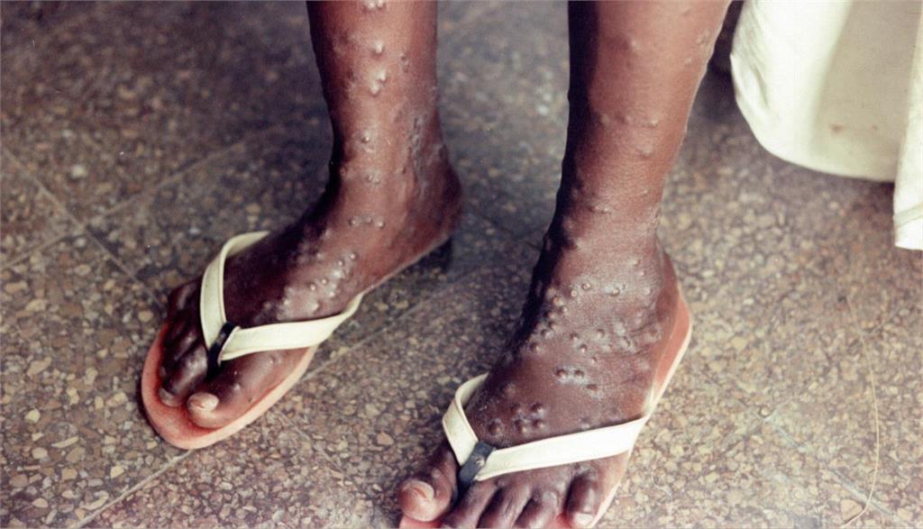 非洲以外首例！巴西41歲男性猴痘奪命