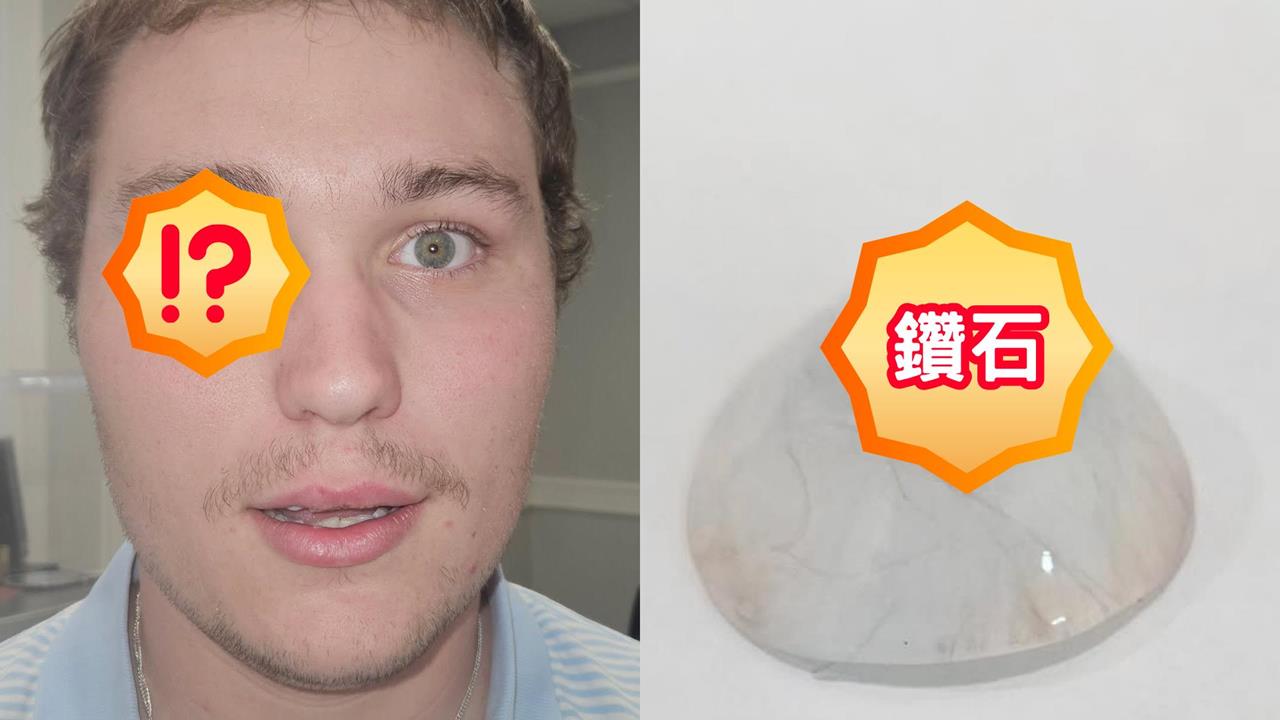 美國珠寶師右眼竟見「2克拉真鑽」!砸6千萬打造「鑽石義眼」網驚:像電影反派