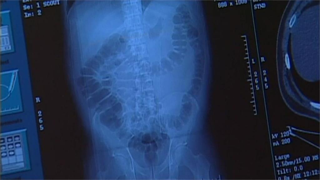 大腸癌年輕化　專家舖「這2因素」有影響