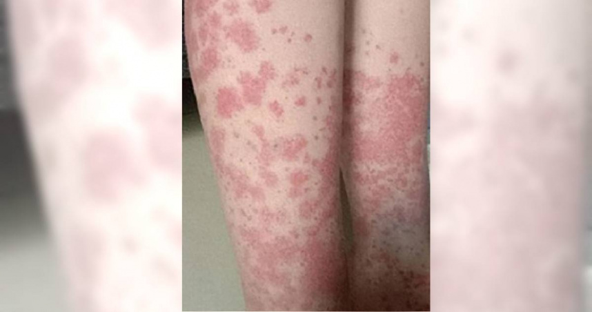 20歲女大生瘋漂染頭髮！2年內每月一次　她全身爆紫斑「剃光頭保命」