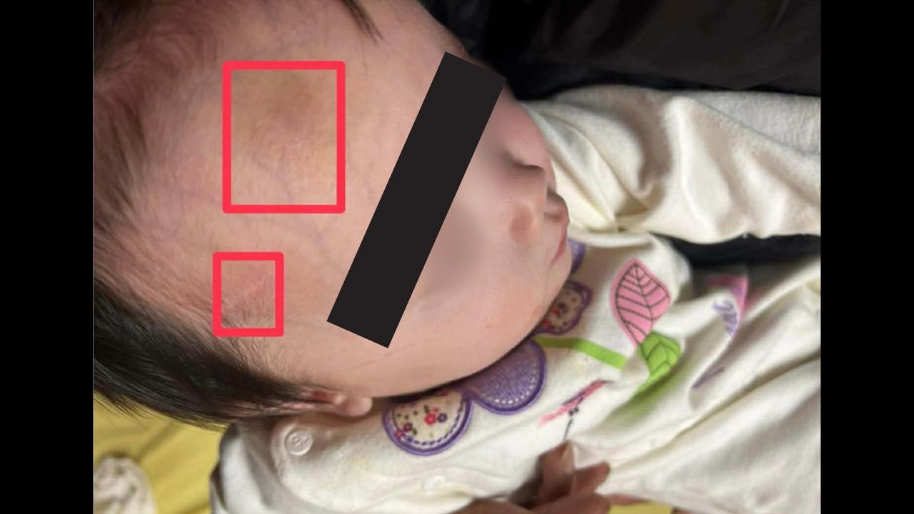 剴剴案翻版?1歲童臉部紅腫瘀青 社工竟稱「被蚊子叮」