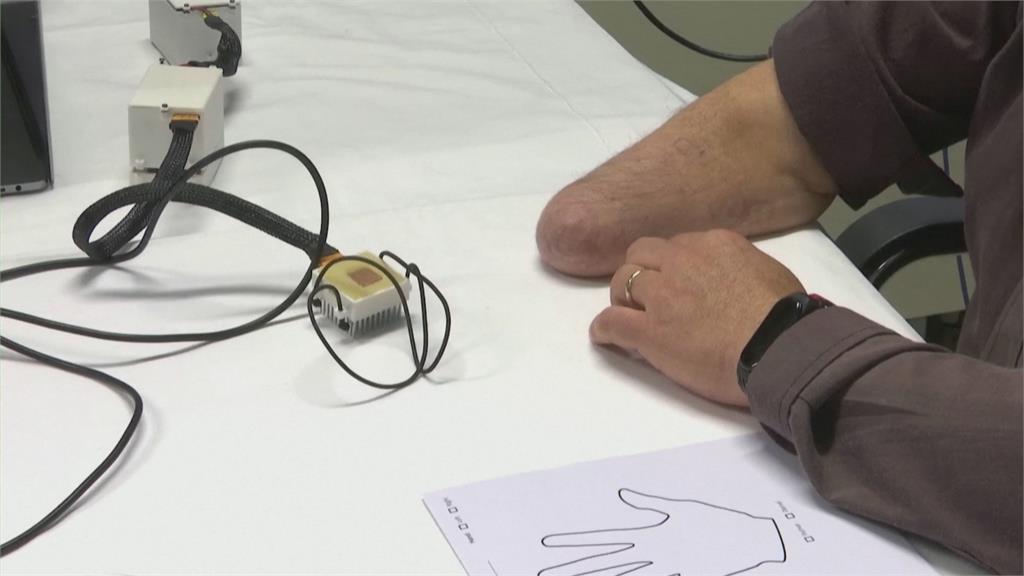 患者截肢術後沒正常知覺　瑞士開發新技術重新體驗感覺